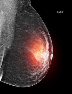 Unilateral craniocaudal (CC) mammogram of the right breast showing benign findings (BI-RADS 2). Medical imaging for cancer screening and women's health.