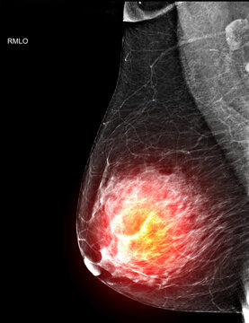 Right MLO view mammogram with a red glowing effect highlighting a potential breast tumor, cancer.