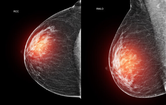 Mediolateral oblique (MLO) mammogram of the left breast displaying benign fibroglandular tissue. Medical imaging for cancer screening, diagnostics, and womens health.