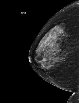 Bilateral craniocaudal (CC) view  mammogram of healthy breasts showing benign tissue (BI-RADS 2).