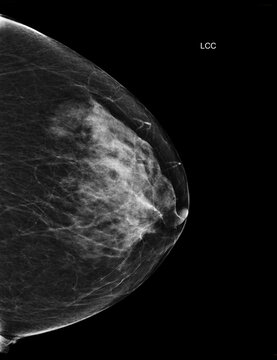 Bilateral craniocaudal (CC) view  mammogram of healthy breasts showing benign tissue (BI-RADS 2).