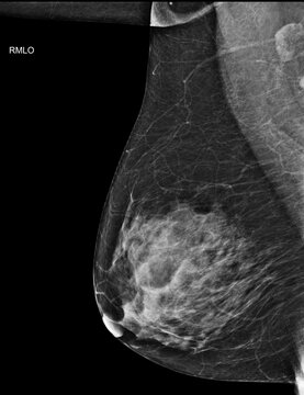Bilateral mediolateral oblique (MLO) mammogram of healthy breasts showing benign tissue (BI-RADS 2) .