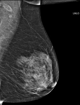 Bilateral mediolateral oblique (MLO) mammogram of healthy breasts showing benign tissue (BI-RADS 2) .