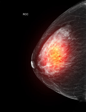 Right craniocaudal (RCC) mammogram featuring a glowing red area to represent breast cancer.