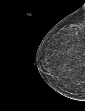 Right craniocaudal (RCC) mammogram scan revealing benign calcifications and cysts (BI-RADS 2). Ideal for breast cancer awareness and women's health screening concepts.