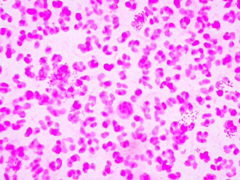 Microscopic image of urethral smear for Gram stain. Gram negative intra and extracellular diplococci are seen. 