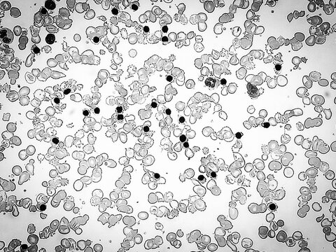 Chronic lymphoproliferative disease. Mature looking lymphocytes, scant cytoplasm, condensed chromatin, frequent smudge cells. Microscopic image of blood cells. 