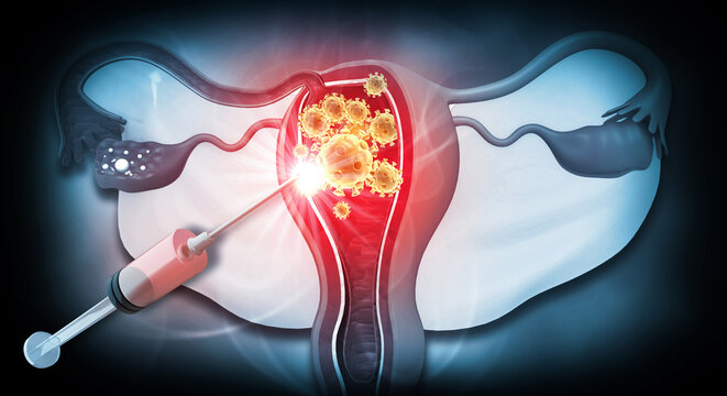 Medical 3D illustration of an inflamed human uterus receiving a targeted antibiotic injection for infection treatment.