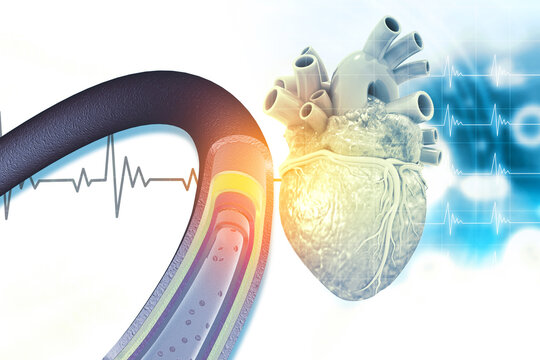 3D medical illustration of a human heart showing narrowed coronary arteries blocked by fatty plaque deposits.