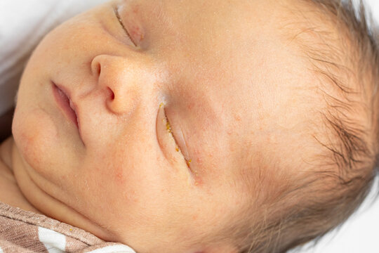 Close-up of a newborn's eye showing lacrimal duct immaturity and early signs of dacryocystitis, with mild tearing around the eye.