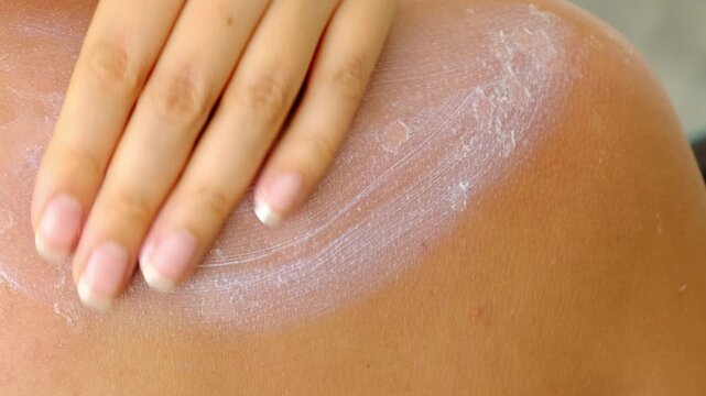 Close-up of a hand applying cream onto peeling sunburned skin on a shoulder. The footage shows treatment and recovery after UV damage, useful for skincare advertising, dermatology topics, or sun