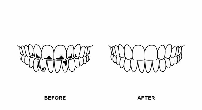 A dental comparison showing decayed teeth before and healthy teeth after treatment