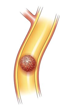 Blood clot obstructing artery, medical illustration of thrombosis.