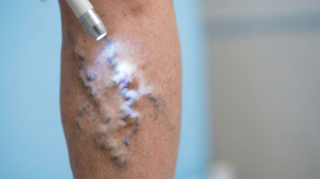 Close up on patient leg during varicose vein treatment. phlebology doctor uses medical laser therapy for removal in clinic, procedure for vascular health
