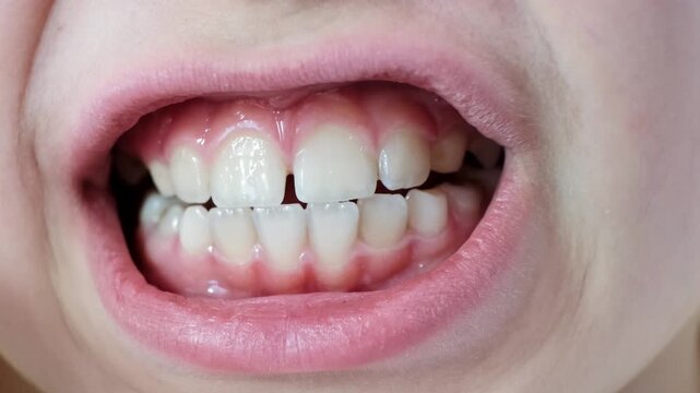 Close-up childs mouth showing clean white molars teeth with gap and healthy gums. Caucasian kid face with closely spaced teeth. Ten year age Diphyodont. Malocclusion, tooth on tooth. Plaque on enamel.