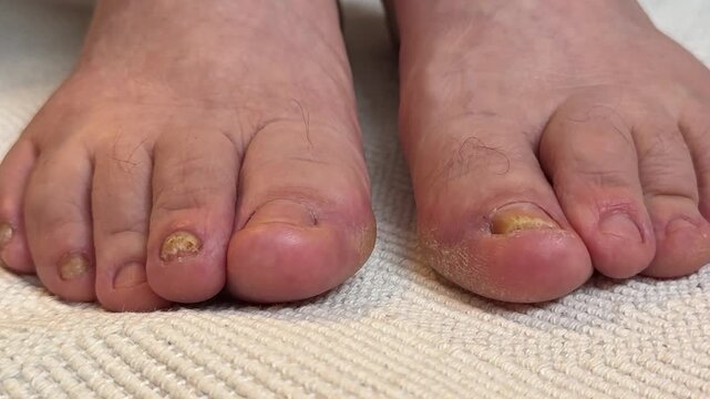 Onychomycosis. Dangerous fungal infection of human toenails on a white background at the doctor. Disease and detachment of the nail plate. Close-up.