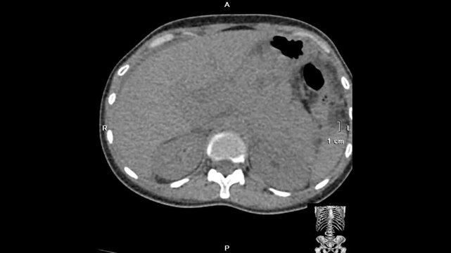 Abdominal CT imaging demonstrates large bilateral solid ovarian masses, predominantly on the right, causing mass effect with anterior displacement of the urinary bladder, superior bowel compression