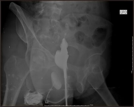 Hysterosalpingography (HSG) X-ray showing uterine cavity and fallopian tubes with contrast injection. Used to evaluate tubal patency and infertility. Original radiology image, not AI generated