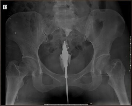 Hysterosalpingography (HSG) X-ray showing uterine cavity and fallopian tubes with contrast injection. Used to evaluate tubal patency and infertility. Original radiology image, not AI generated