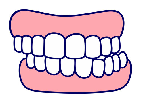 Crowded Teeth and Malocclusion, Irregular Bite Dental Alignment Problem