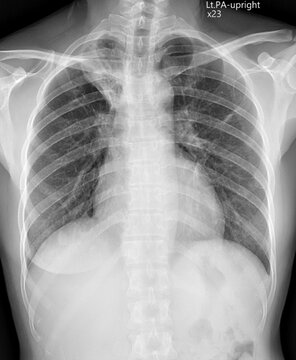 Medical Chest X-ray Showing Pulmonary Infection and tuberculosis Infiltrates in Human Lungs.