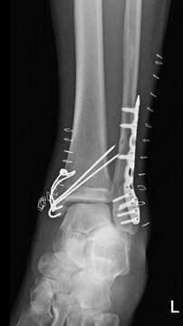 Postoperative Ankle X-ray Showing Surgical Internal Fixation of Malleolar Fracture with Plates and Screws.