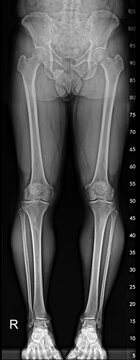 Full-Length Lower Limb X-ray Scanogram for Alignment and Leg Length Study.