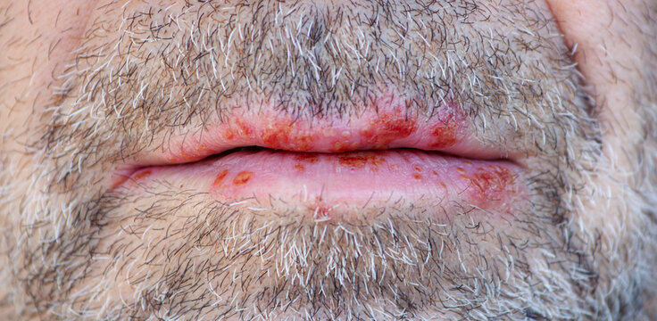 man with beard. Close-up of a man's face with a herpes simplex virus infection, cold sores on the lower and upper lips. Herpes simplex-Virus concept. 