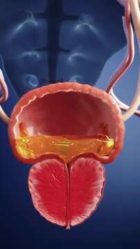 Difficulty urinating, prostatitis and redness, enlargement of the prostate, compressing the bladder and urethra, leading to urinary tract infections. Urinary system diseases, medical 3D animation.