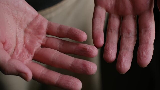 Close up male hands displaying wrinkled and shriveled fingertips, temporary skin condition caused by prolonged immersion in water, illustrating body natural response