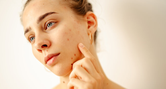 A close-up of a young woman with problematic skin touching her face in a brightly lit room. The woman examines her blemishes in a small mirror on a sunny day. Health and skincare concepts.