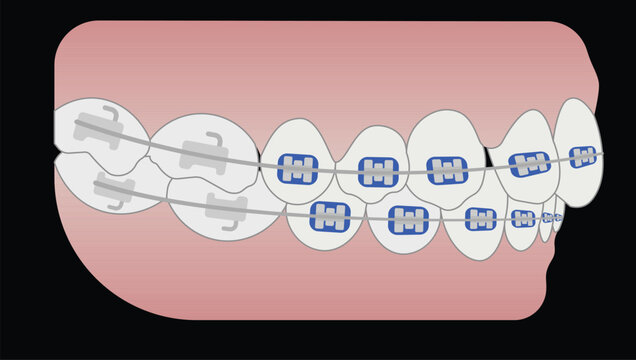 Teeth with Braces and Archwire