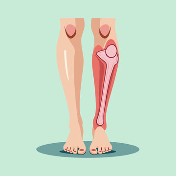 An illustration of lower legs on a mint background with a red inflamed tibia bone. This medical diagram depicts shin splints or a stress fracture, with copy space.