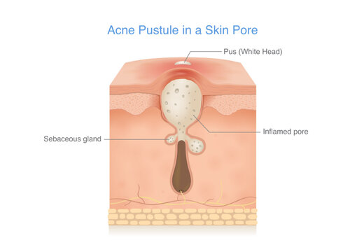 Acne pustule inside a skin pore showing a clogged pore filled with pus (whitehead), caused by excess sebum and bacteria. Inflamed pore and sebaceous gland in a cross section skin diagram.  Medical ill