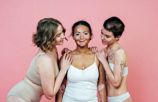 Group of multiethnic women with different kind of skin posing together in studio. Concept about body positivity and self acceptance