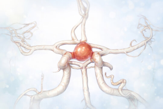 Medical illustration of a cerebral aneurysm located between the internal carotid arteries and below the anterior communicating artery  highlighting rupture risk and hemorrhagic stroke