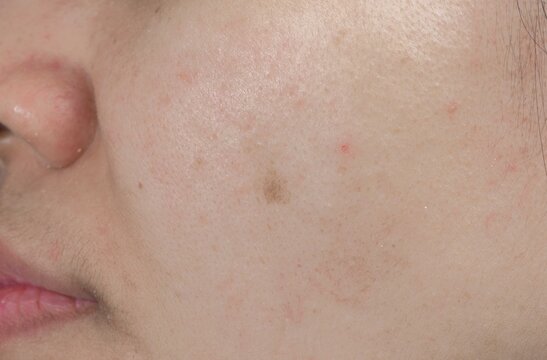 Asian woman with acne spot on facial skin before laser dermatology treatment. Pigmentation issue and skincare concern. Acne blemish and dark spot before laser skincare procedure in dermatology clinic.
