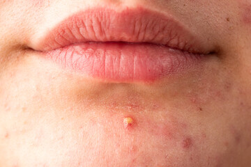 Fototapeta premium Dermatology concept with acne skin pores. Acne on skin closeup photo. Irritated skin with pimples acne texture. Detailed skin with acne.
