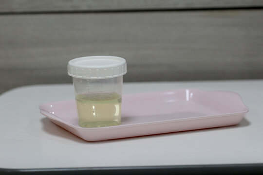 Urine sample in a plastic specimen cup on a pink tray, medical lab test and health checkup concept.