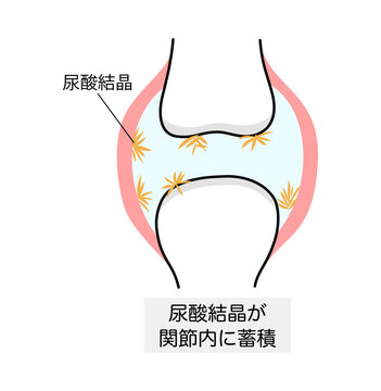 痛風における尿酸結晶が沈着した関節のイラスト