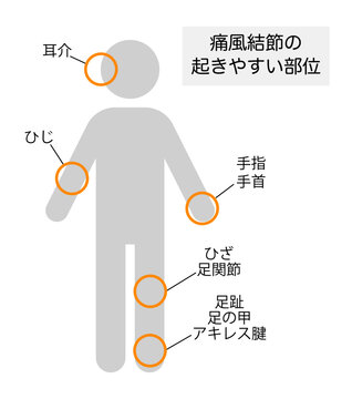 痛風結節が起きやすい部位を説明したイラスト