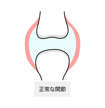 痛風における正常な関節のイラスト