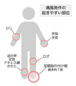 痛風発作が起きやすい部位を説明したイラスト