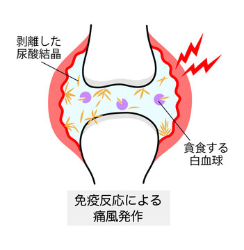痛風発作を起こした関節のイラスト