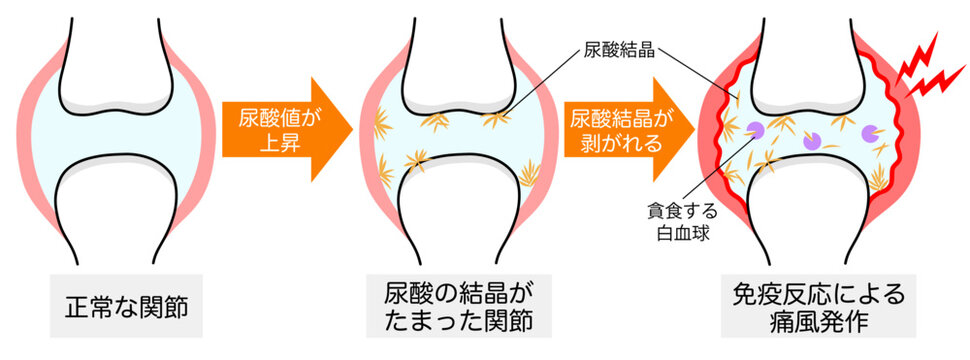 正常な関節・尿酸結晶ができた関節・痛風発作が起きた関節の比較イラスト