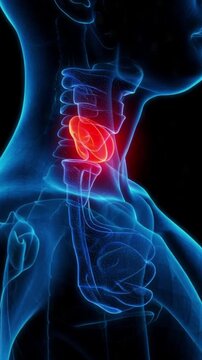 Thyroid Gland with Highlighted Abnormal Growth, Medical Anatomy Visualization Representing Severe Thyroid Condition, Internal Medicine Study, and Healthcare Concept