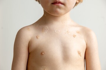 Naklejka premium Young Boy with Skin Condition on Chest and Shoulder, Dermatology and Health Concerns
