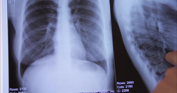 X-ray images of the lungs and chest are being reviewed by a doctor on a white background. Preventive examination of diseases.