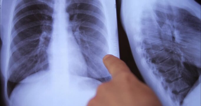 X-ray images of the lungs and chest are being reviewed by a doctor on a white background. Preventive examination of diseases.
