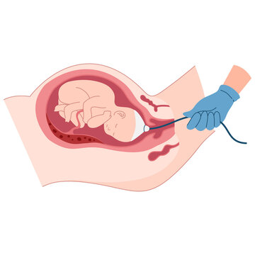 Medical professional performs a fetal scalp electrode procedure on a developing baby in the womb.